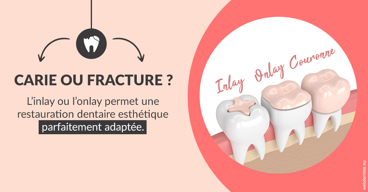 https://scp-cabinet-dentaire-drs-abehsera.chirurgiens-dentistes.fr/T2 2023 - Carie ou fracture 2