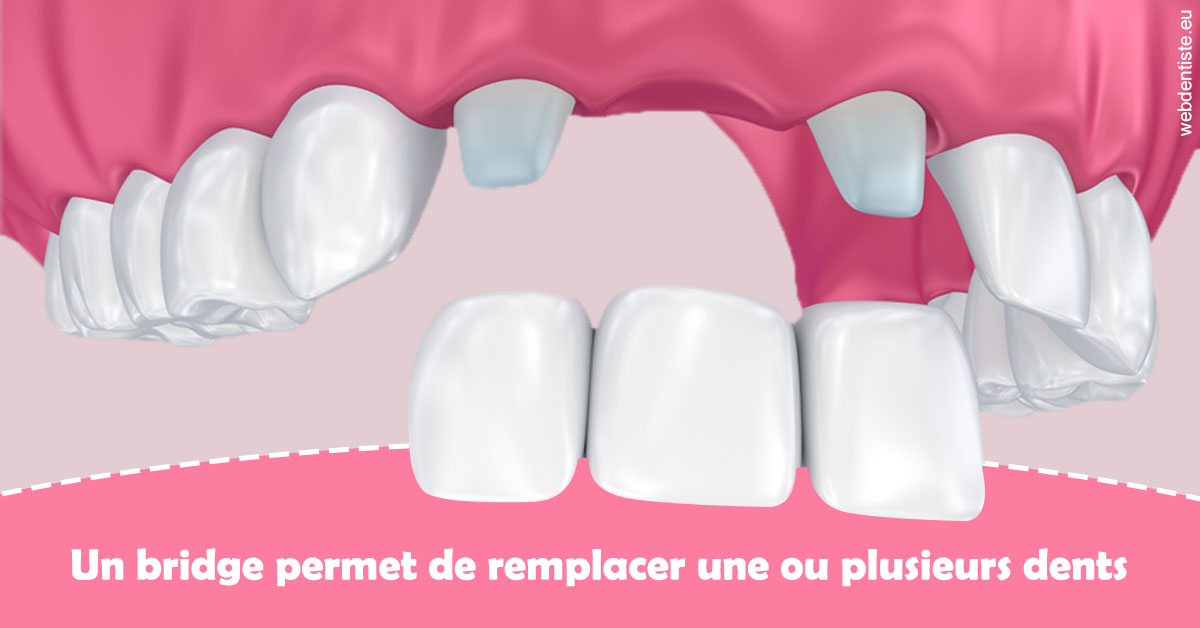 https://scp-cabinet-dentaire-drs-abehsera.chirurgiens-dentistes.fr/Bridge remplacer dents 2