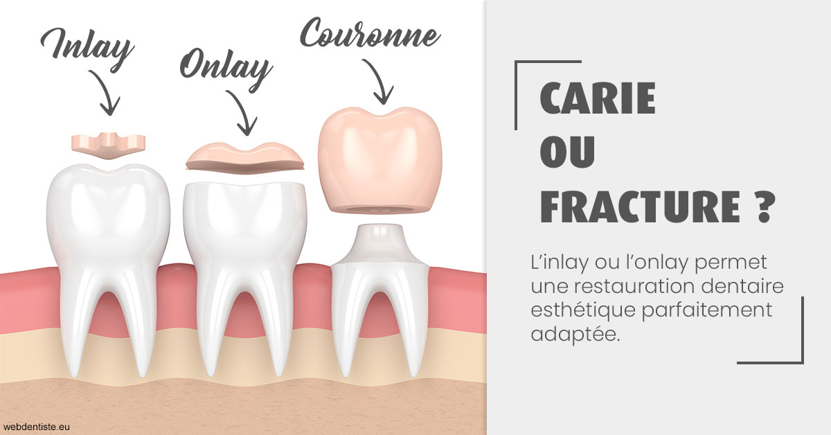 https://scp-cabinet-dentaire-drs-abehsera.chirurgiens-dentistes.fr/T2 2023 - Carie ou fracture 1