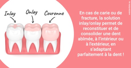 https://scp-cabinet-dentaire-drs-abehsera.chirurgiens-dentistes.fr/L'INLAY ou l'ONLAY 2