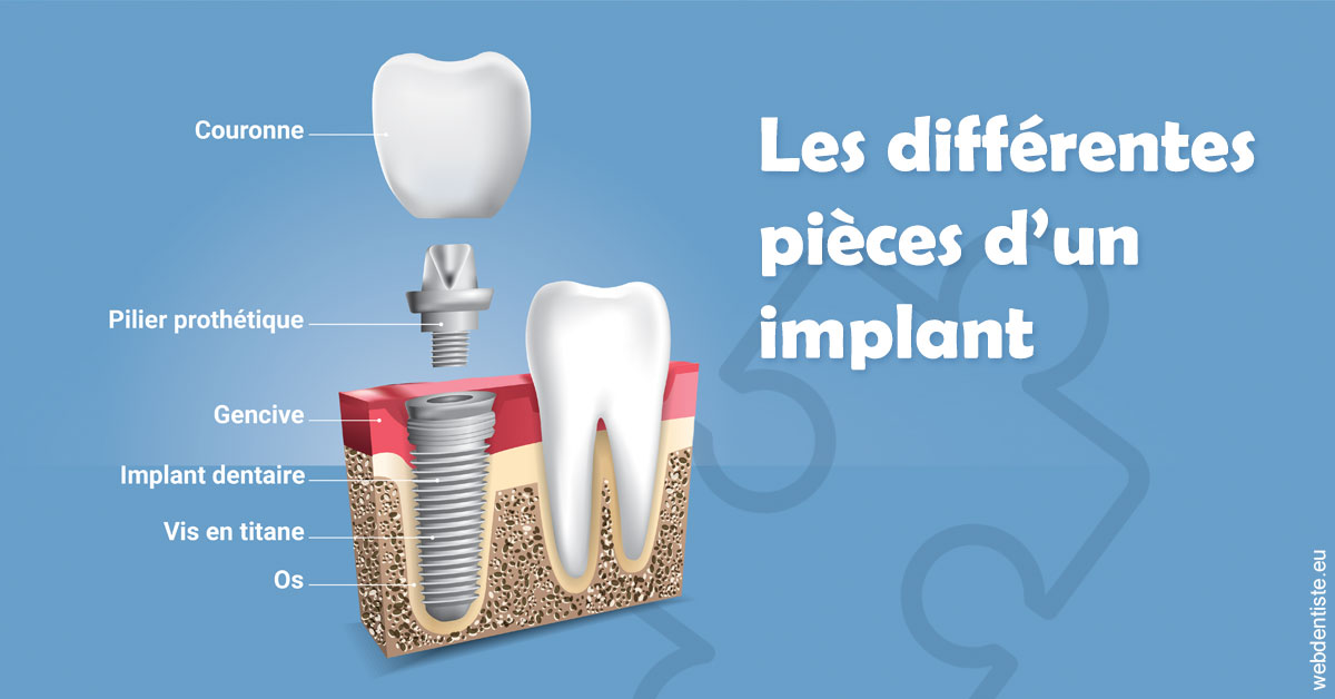 https://scp-cabinet-dentaire-drs-abehsera.chirurgiens-dentistes.fr/Les différentes pièces d’un implant 1