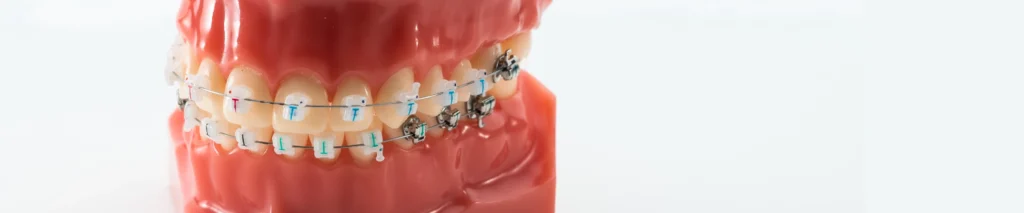 Traiter une malocclusion